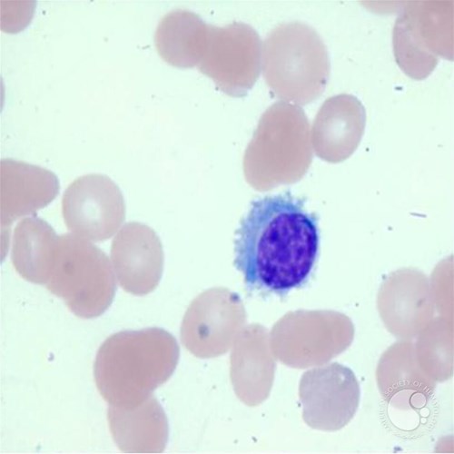 Hairy Cell Leukemia – Hairy Cells Microscopic Pathology Image